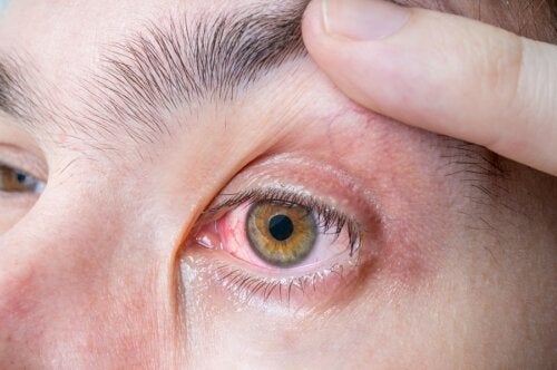 Меланома глаза: симптомы и причины